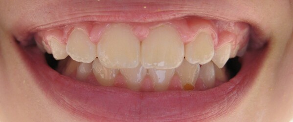 Tartar Recall lead image